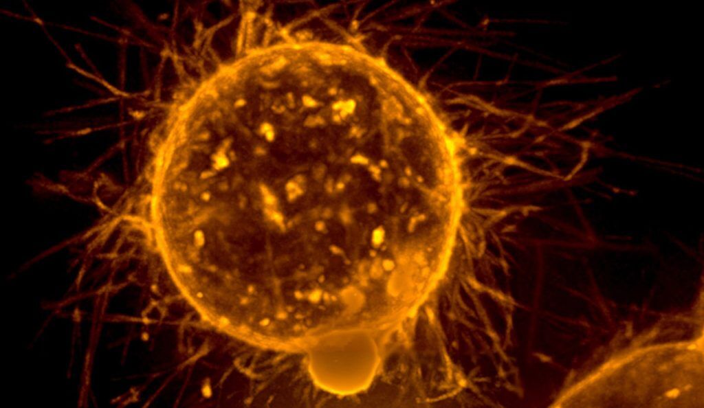 an illustration of a breast tumor cell in orange against a black background