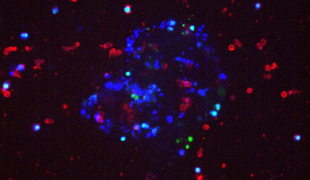 Screenshot of healthy natural killer cells attacking invading breast tumor cells.